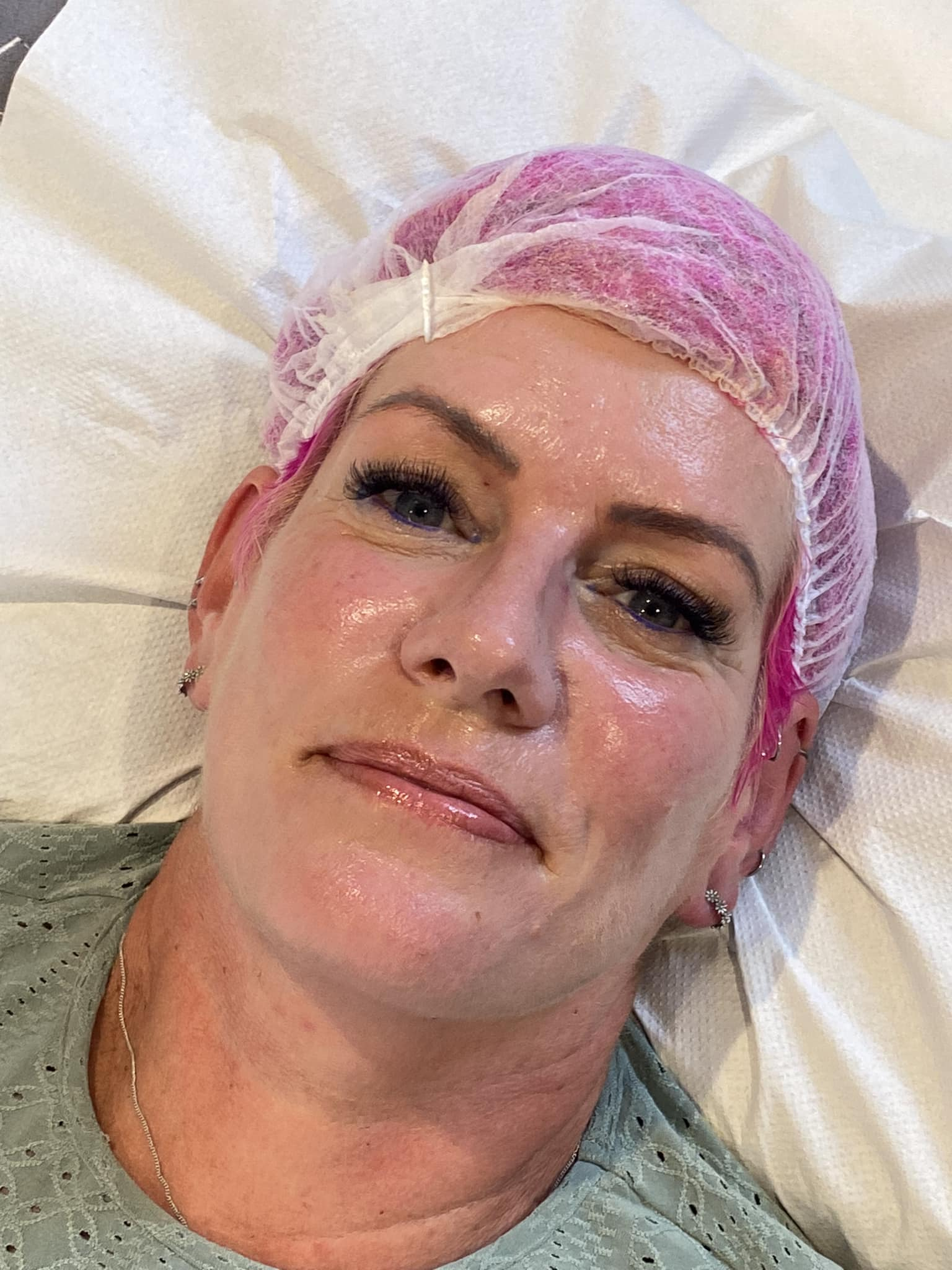 Dermaplaning