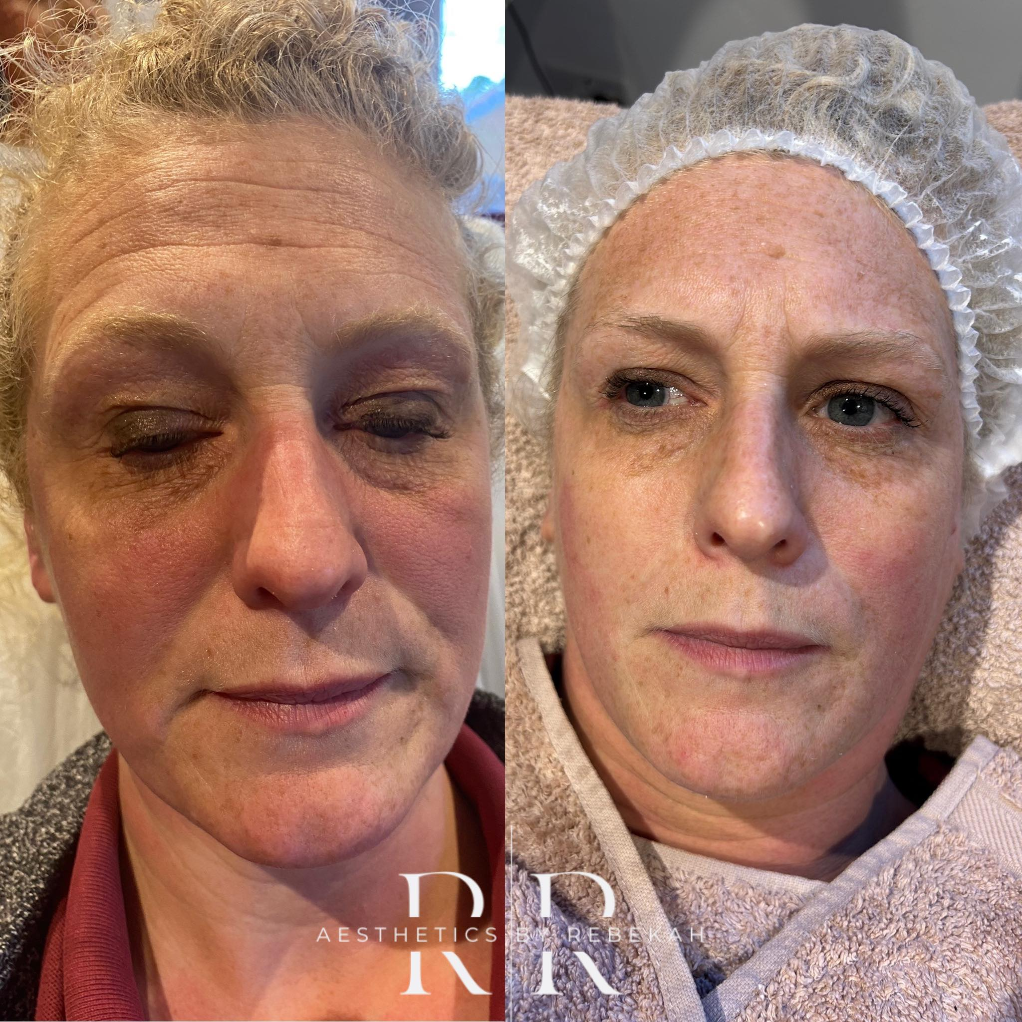 Radio Freq + Microneedling