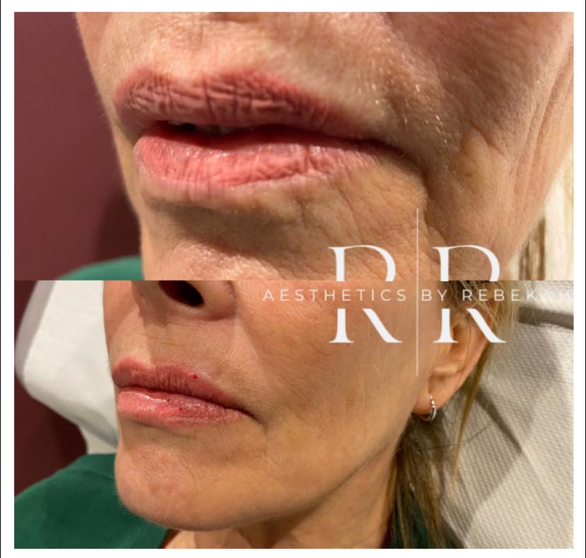 Lip Filler